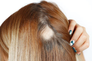 alopecia feminina