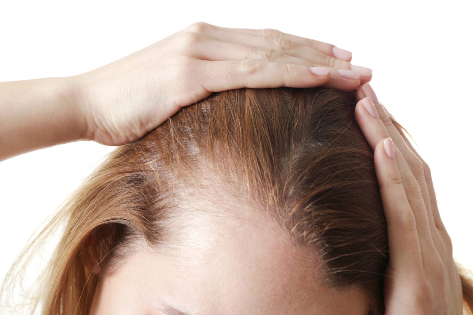 Quais são os principais sintomas de alopecia areata?