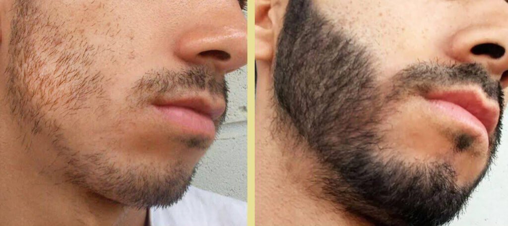 Tratamento para crescimento da barba Fernando Marques Cl nica