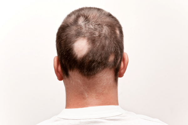 O Que é Alopecia, Quais Os Tipos E Tratamentos Para A Condição ...