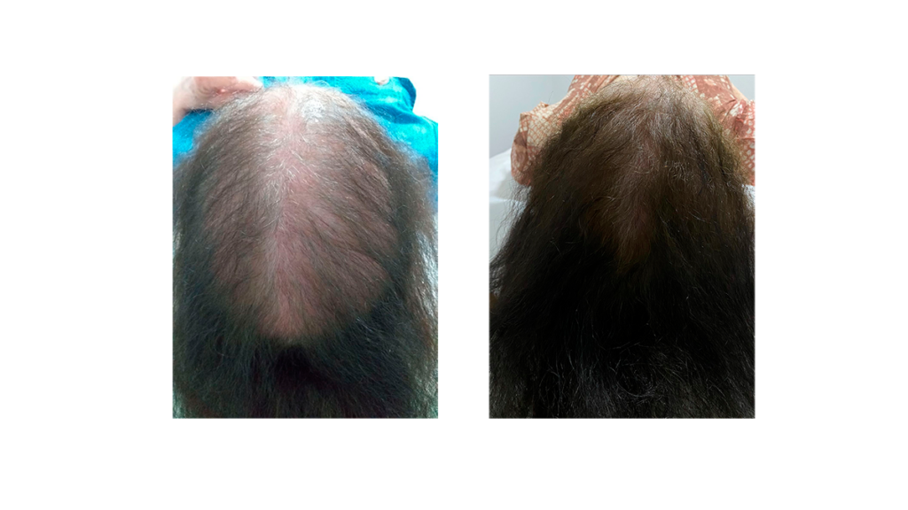 alopecia-androgenetica