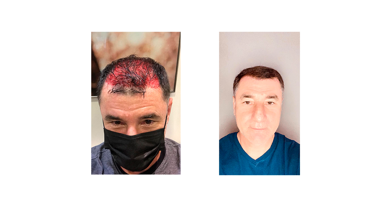 antes-depois-devanir-2